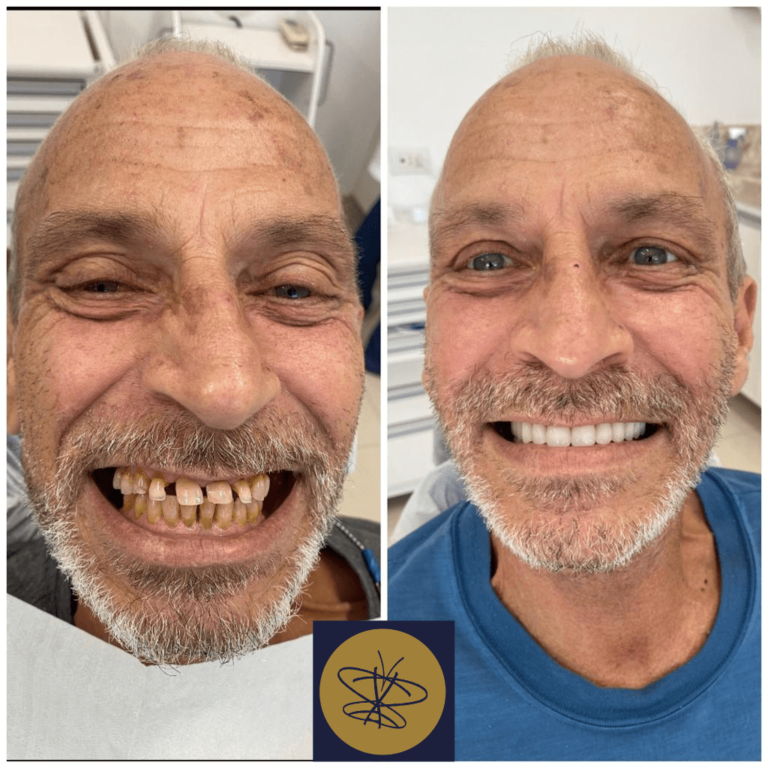 Antes e depois Mauricio