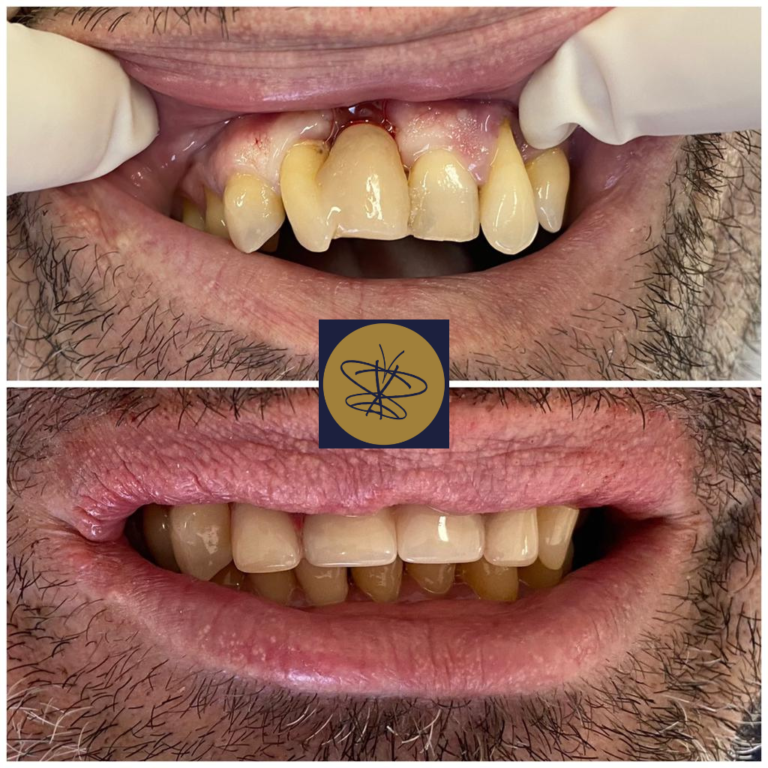 Paulino (implantes unitários) OK